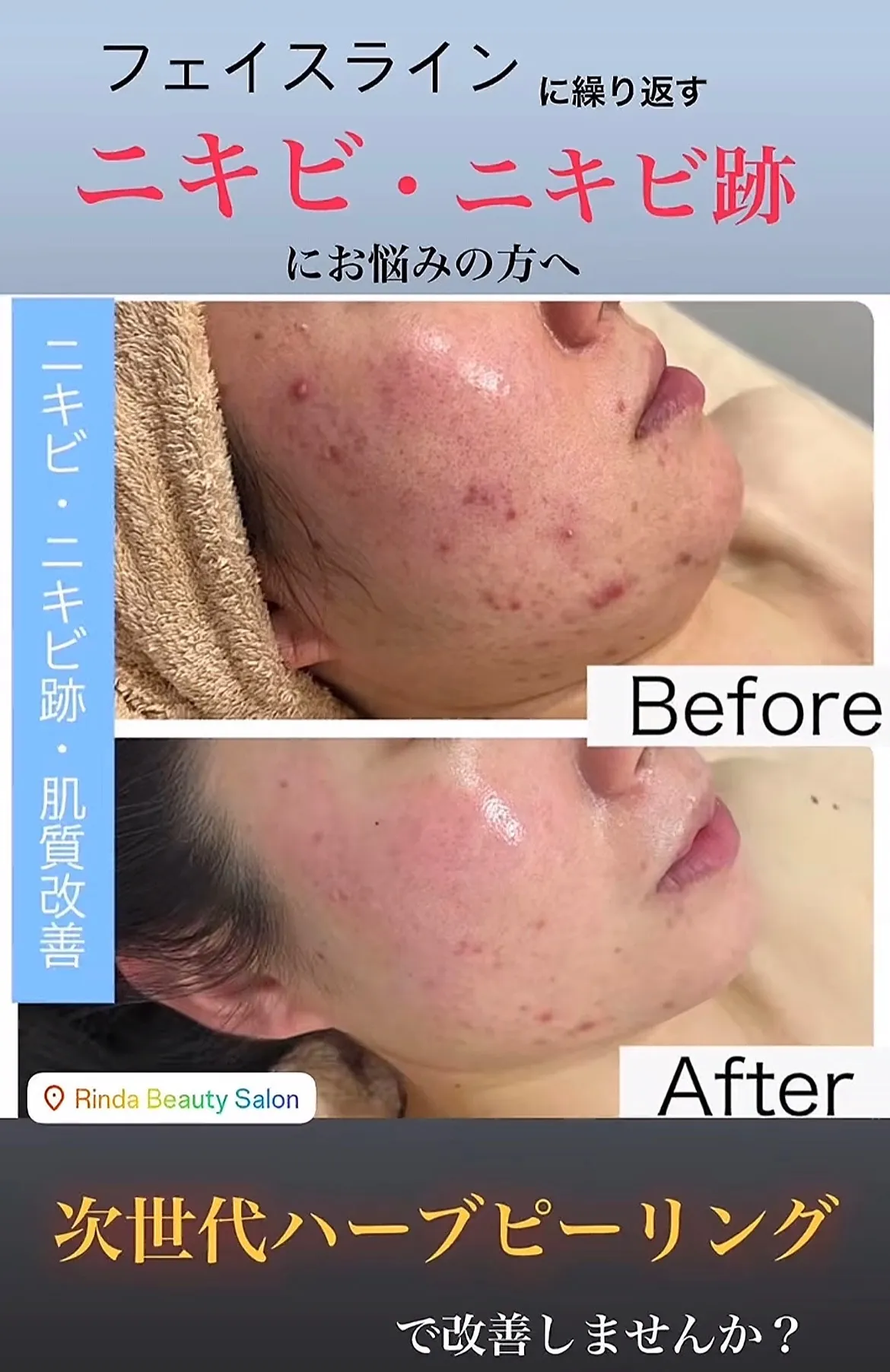尼崎で「繰り返すニキビ・ニキビ跡」を肌質改善｜次世代ハーブピーリングをRindaで