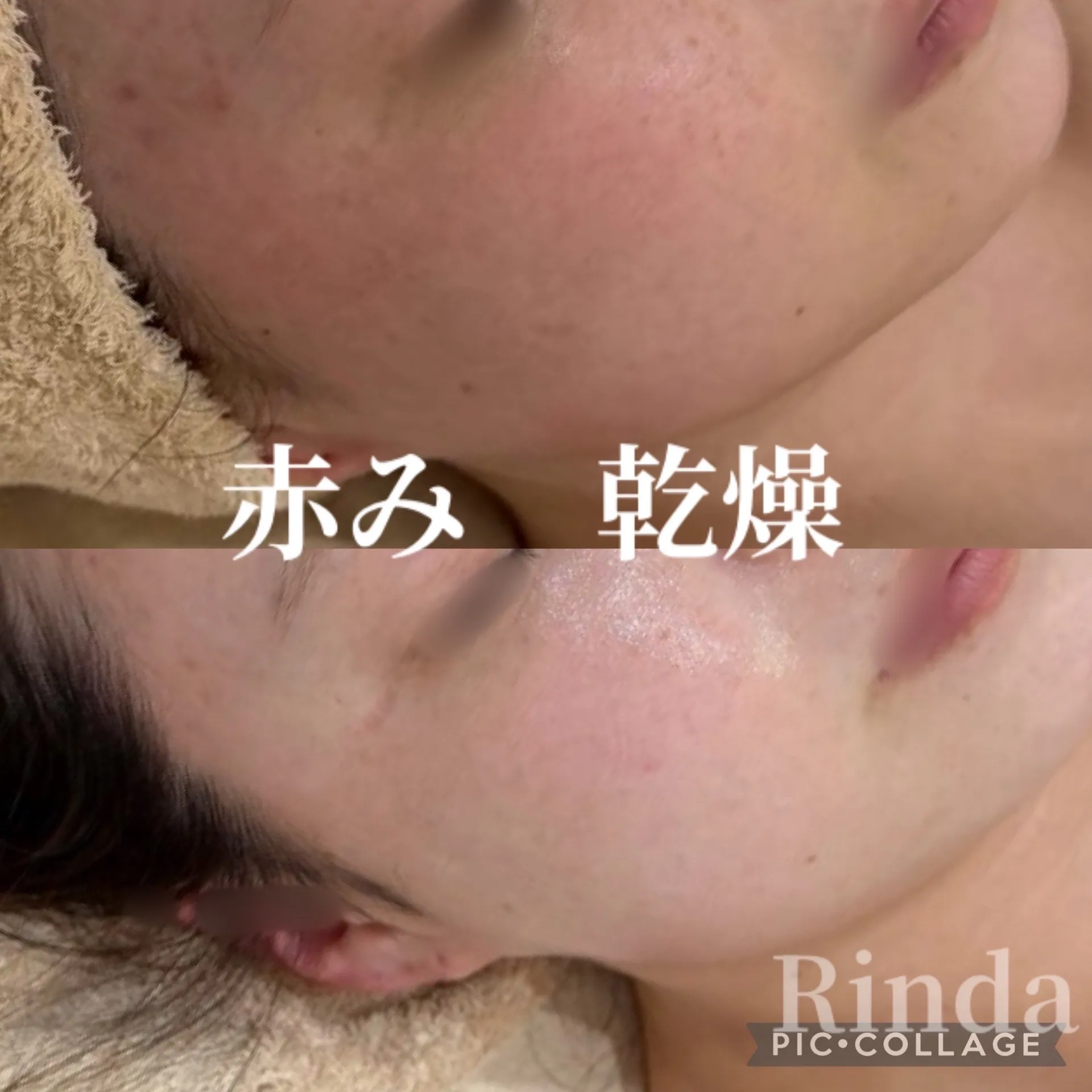 【尼崎エステ】乾燥・赤み・敏感肌・つっぱりに｜まずは水分補給から始める肌質改善は尼崎リンダへ