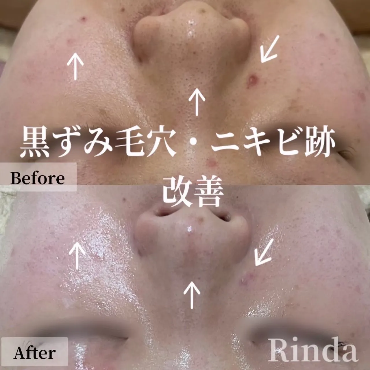 尼崎で黒ずみ毛穴・ニキビ跡の肌質改善なら｜Rinda Beauty Salonリンダビューティーサロン（尼崎エステ）