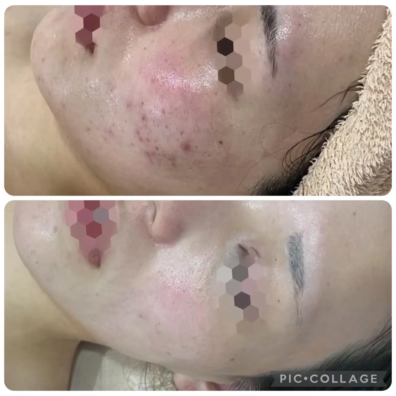 繰り返す毛穴・赤み・ニキビを肌質改善|尼崎エステ Rinda Beauty Salonリンダビューティーサロン