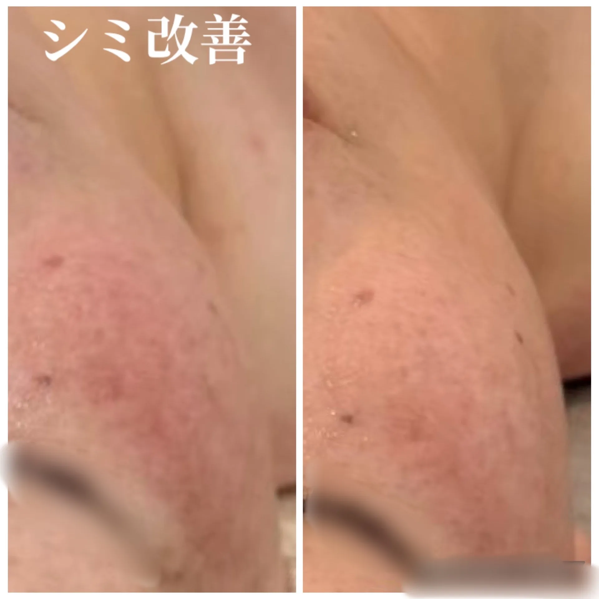 JR尼崎駅近郊】何をしてもダメだった頑固なシミに!肌質改善専門サロンだから叶う、本気のシミケア 本文: