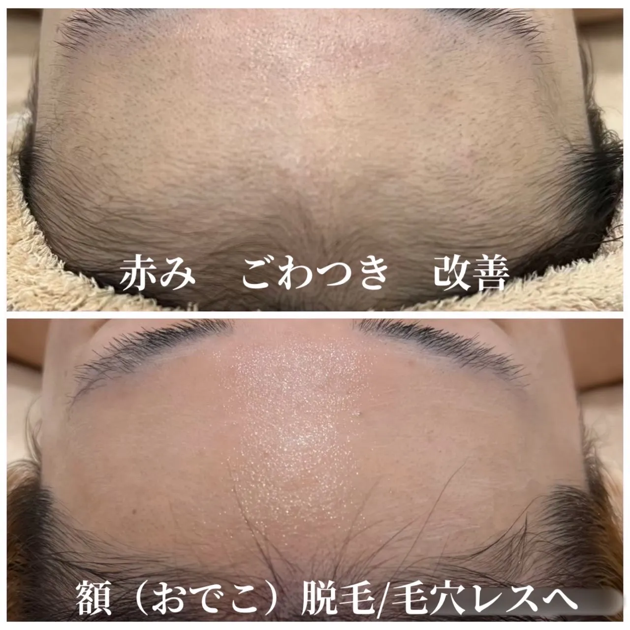 【尼崎】額の赤み・ごわつき・毛穴が気になる方へ｜肌質改善×額脱毛でなめらかな肌へ