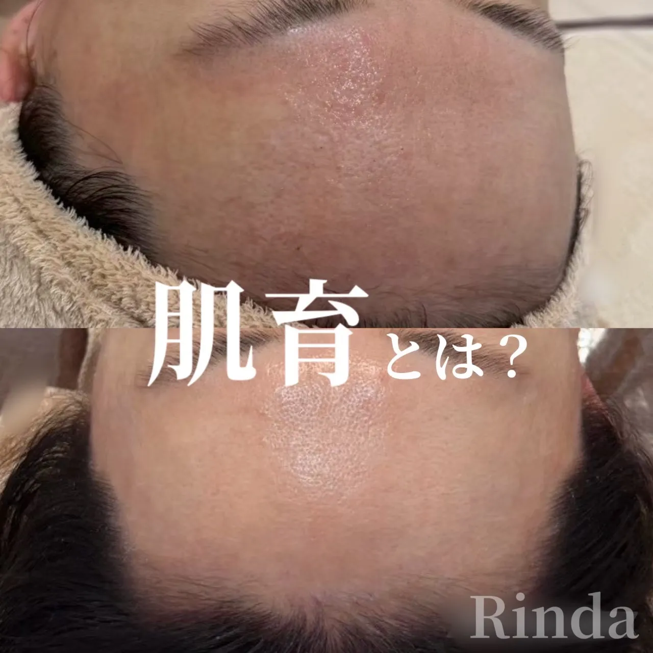 尼崎の肌質改善|肌育とは?赤み・乾燥・毛穴・ニキビを繰り返さない肌管理