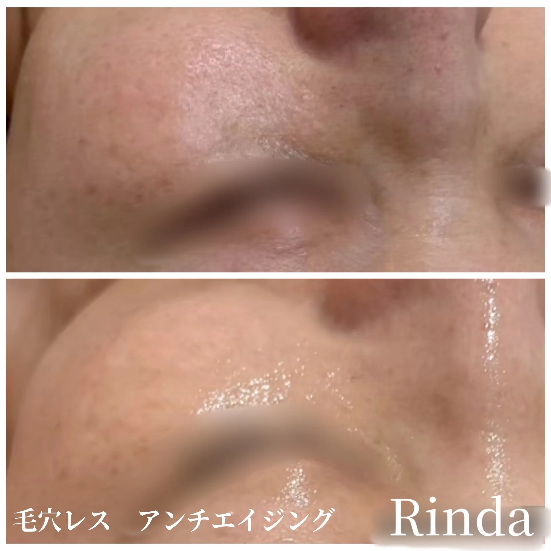 JR尼崎でアンチエイジング・シミ・くすみ・美白ケアなら｜肌質改善Rinda Beauty Salonリンダビューティーサロンで改善