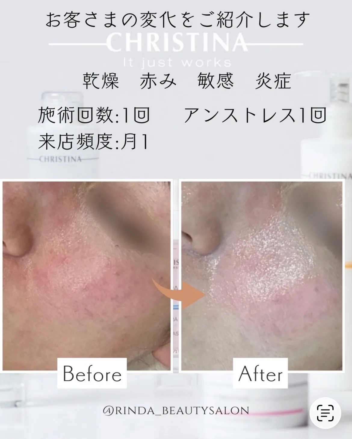 JR尼崎駅前サロン【乾燥・赤み・敏感肌】肌質改善は「1回で終わり」ではなく、肌を安定させることが大切！Rinda Beauty Salonリンダビューティーサロンで改善しませんか？