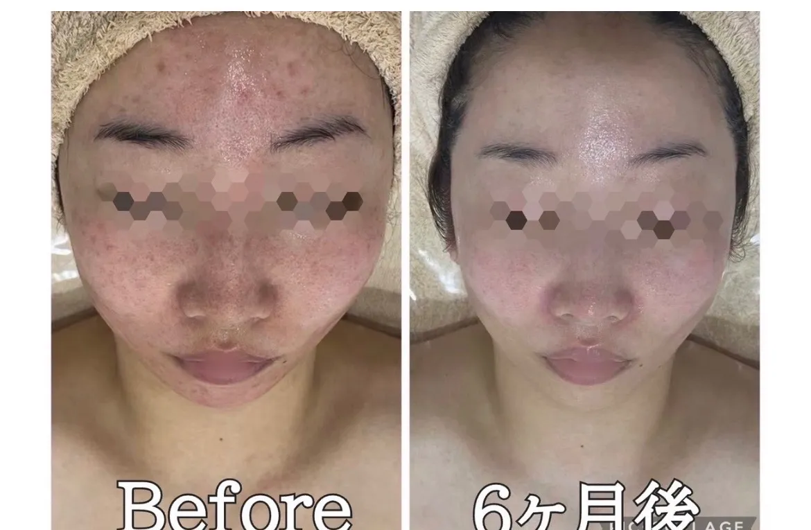 尼崎駅前サロン【症例写真】赤み・ニキビ・肌トラブルから6ヶ月！アンストレス×ビオフィート×ハーブピーリングでツヤ透明肌へ導いた症例解説